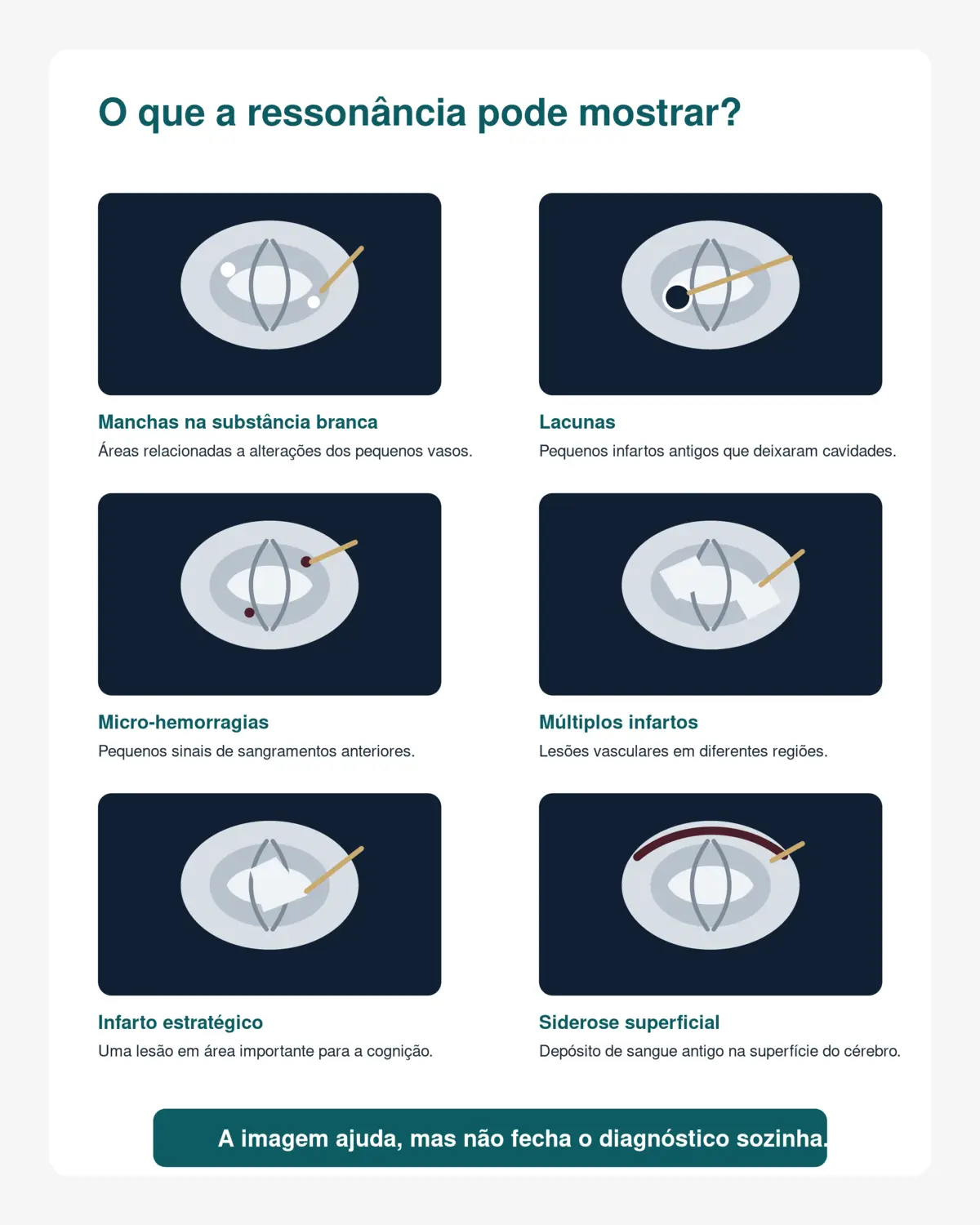 Infográfico médico mostrando alterações da substância branca, lacunas, micro-hemorragias, múltiplos infartos, infarto estratégico e siderose superficial