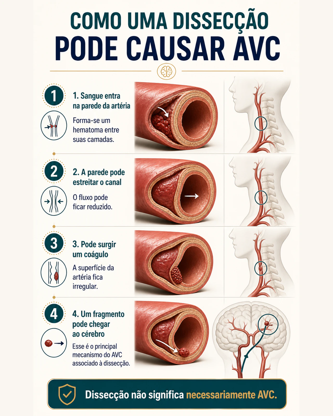Infográfico explicando como uma dissecção se forma na parede arterial e pode causar um coágulo
