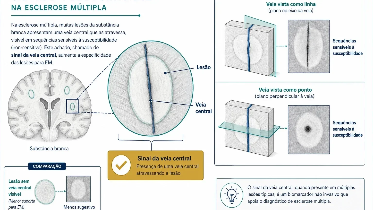 Esquema didático do sinal da veia central em uma lesão de substância branca