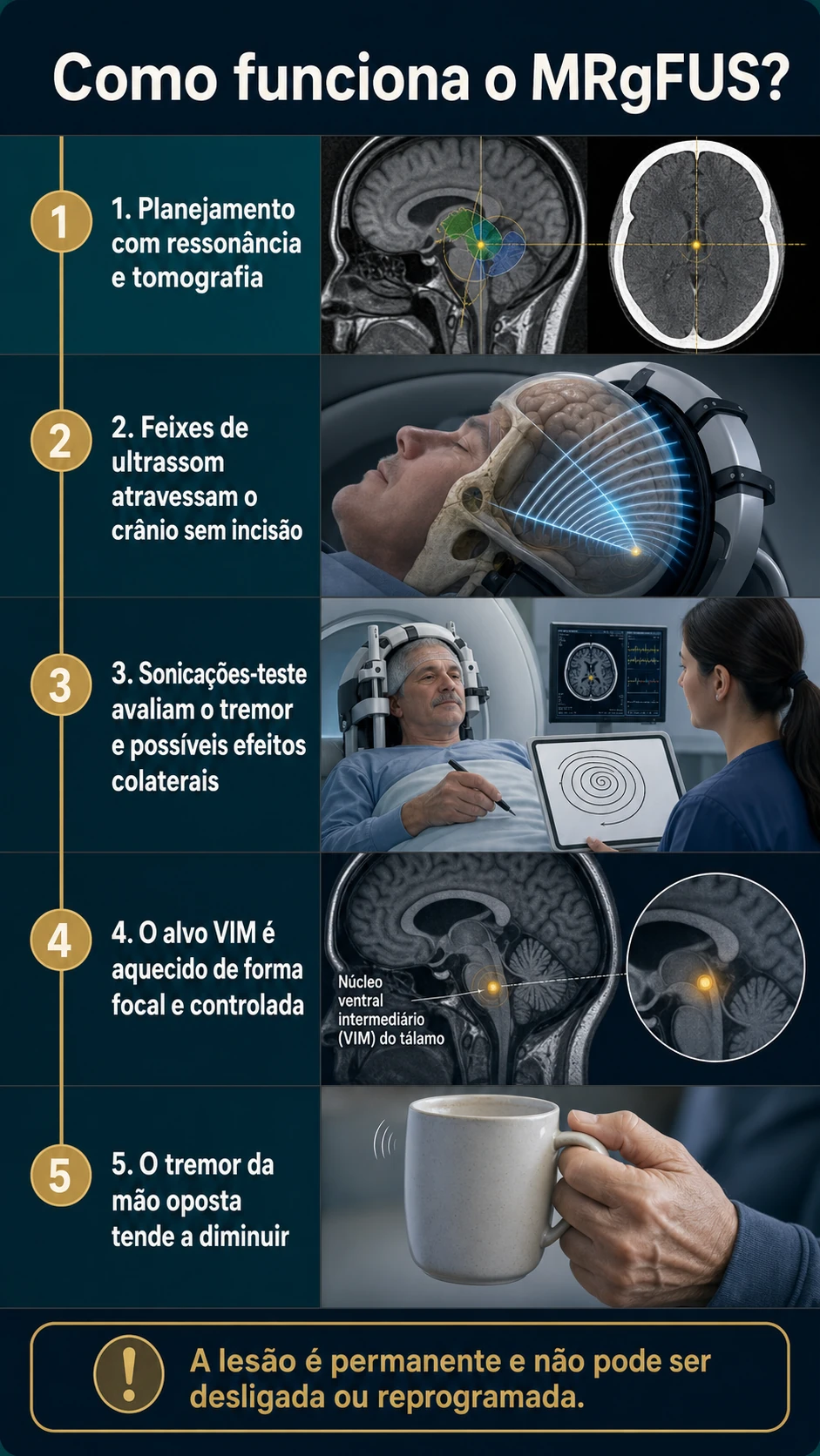 Infográfico explicando as etapas do MRgFUS, desde o planejamento até a avaliação do tremor